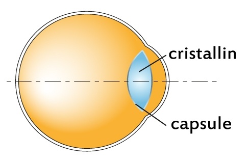 cataracte