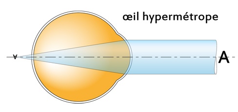 œil hypermétrope