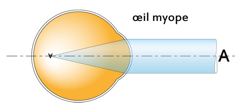 œil myope